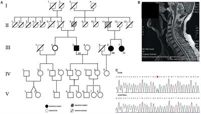Clinical and Functional Characterization of a Missense ELF2 Variant in a CANVAS Family